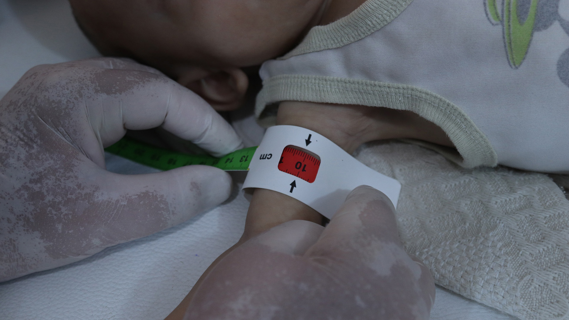 Doctor Firas Hamdo measures an infant’s arm to check for indications of malnutrition at al-Nour hospital in Idlib province.