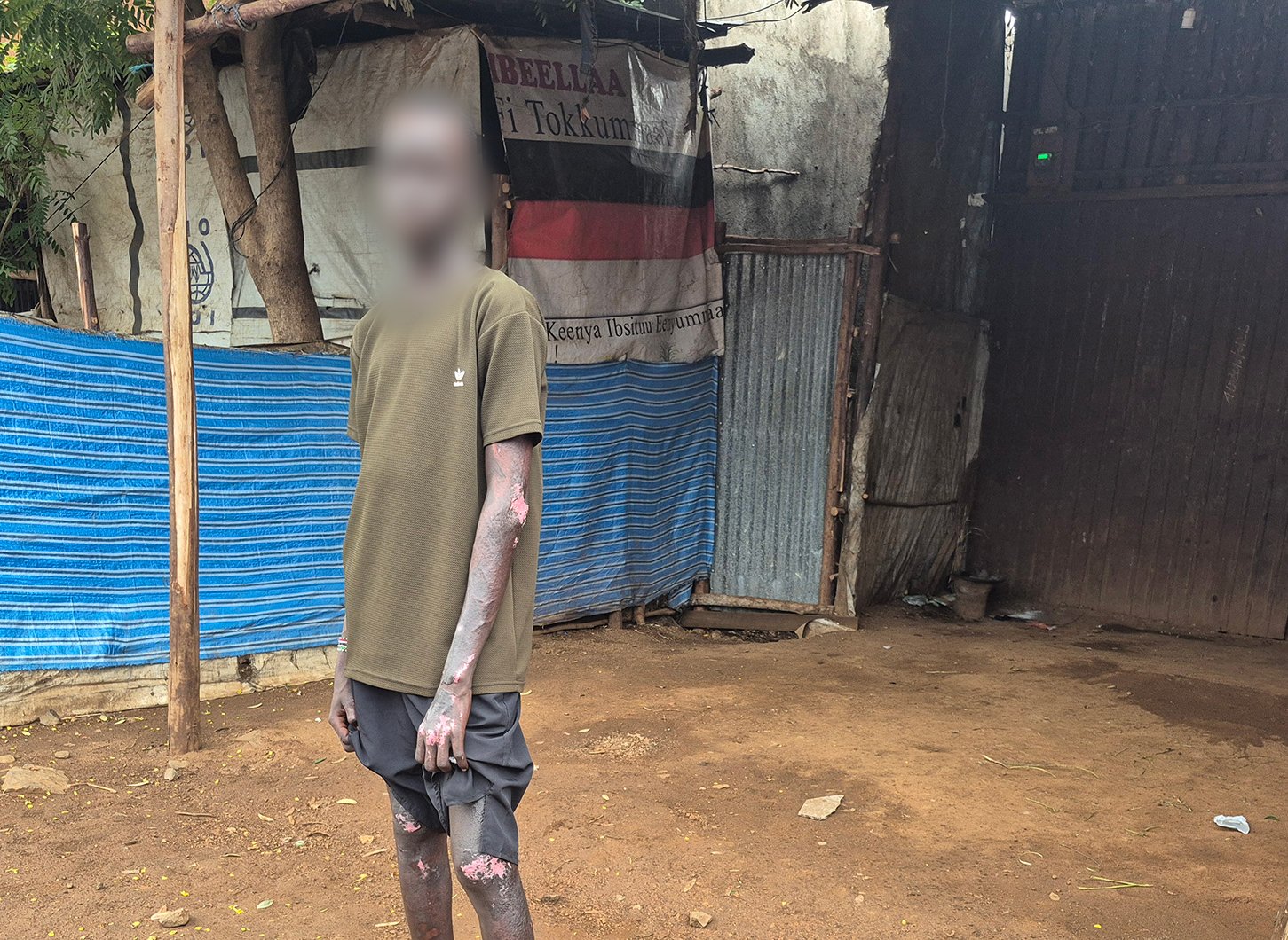 A photo of a young man with his face blurred for safety show how his body and face were burnt in a bombardment with incendiary weapons.