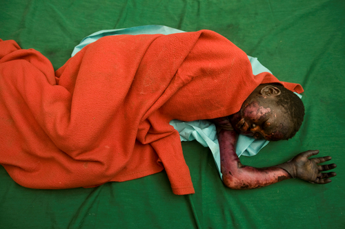 Child with burns in Um Serdiba Village