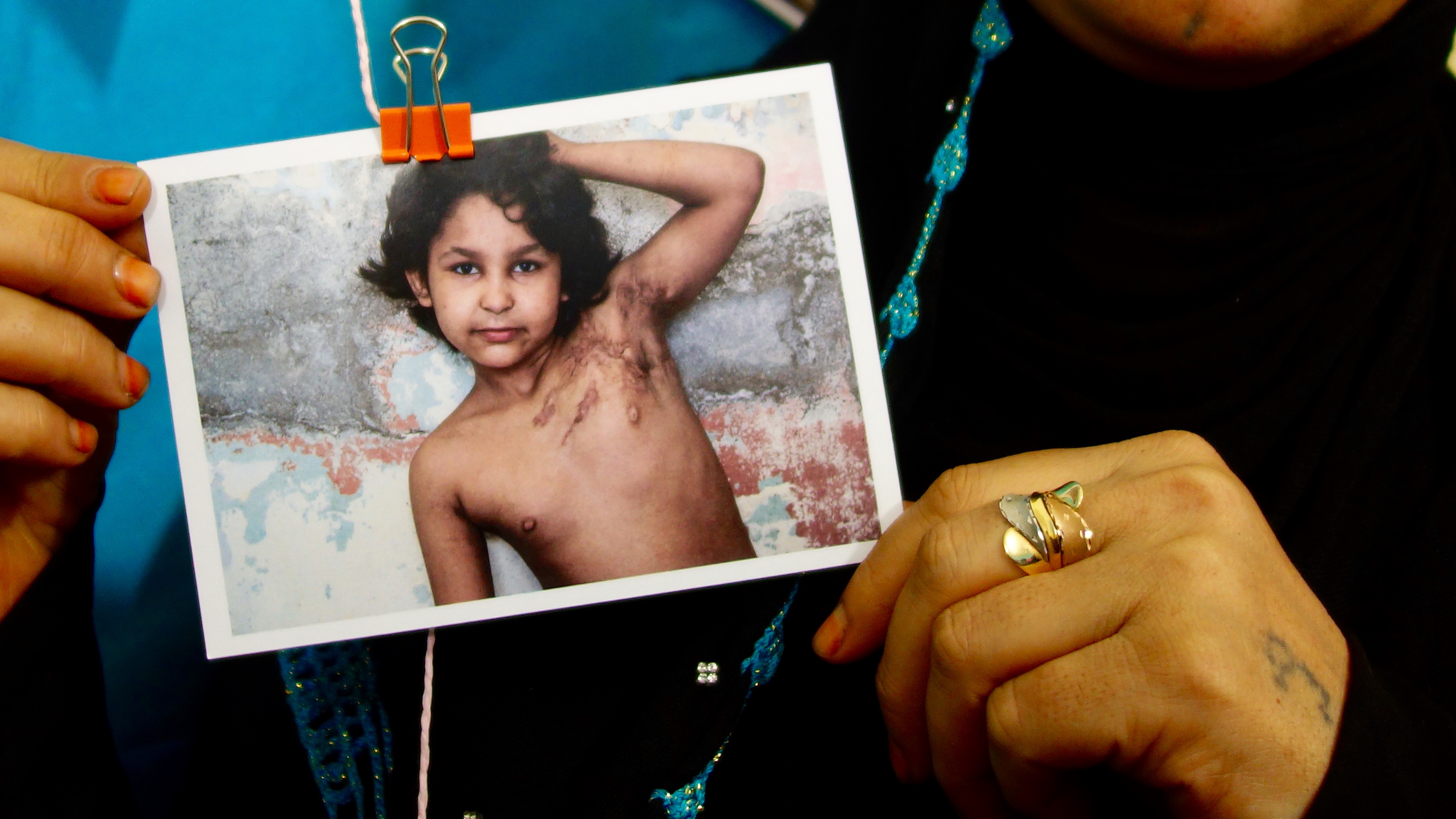 A mother holds a photo she took of her scarred daughter