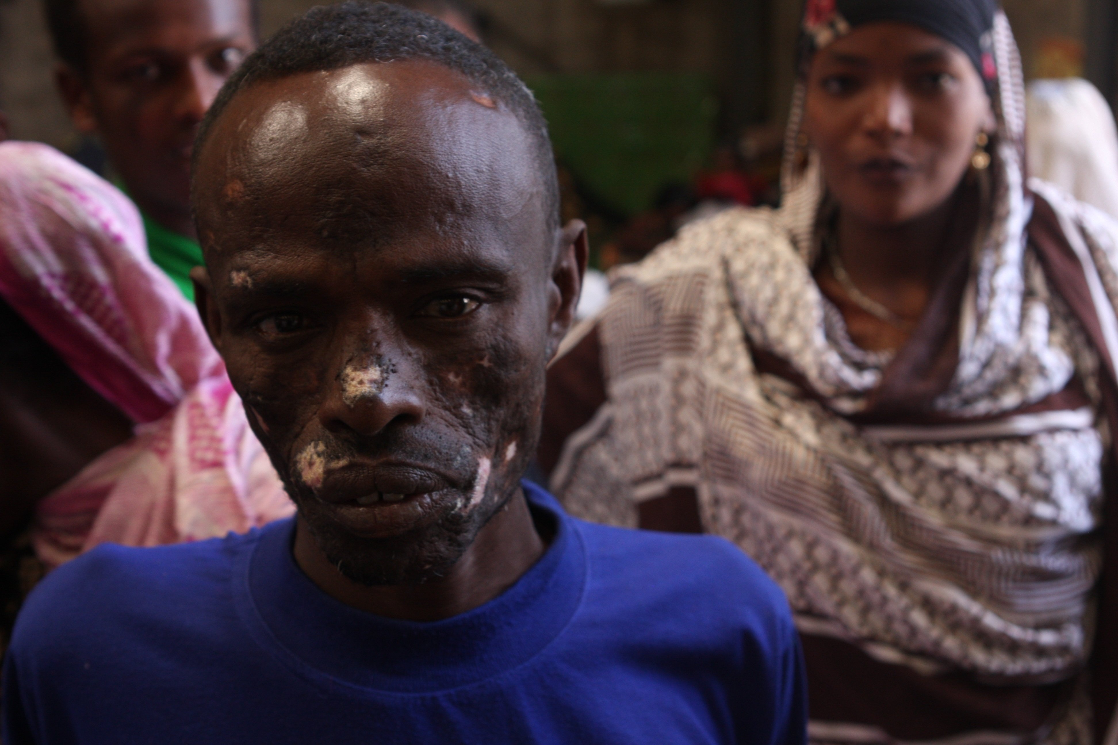 Ethiopia man burnt