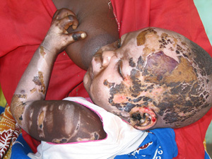 [Sudan] Baby burnt in Darfur bombing raid.