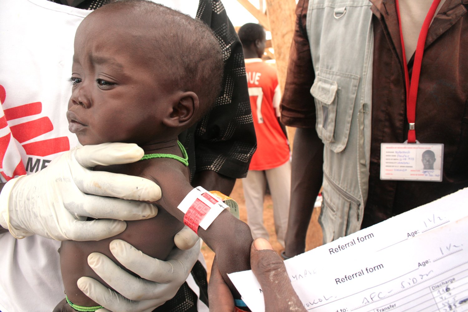 A health worker uses the strip on the child's upper hand to determine the level of malnutrition. In this case, the child was found to be malnourished.