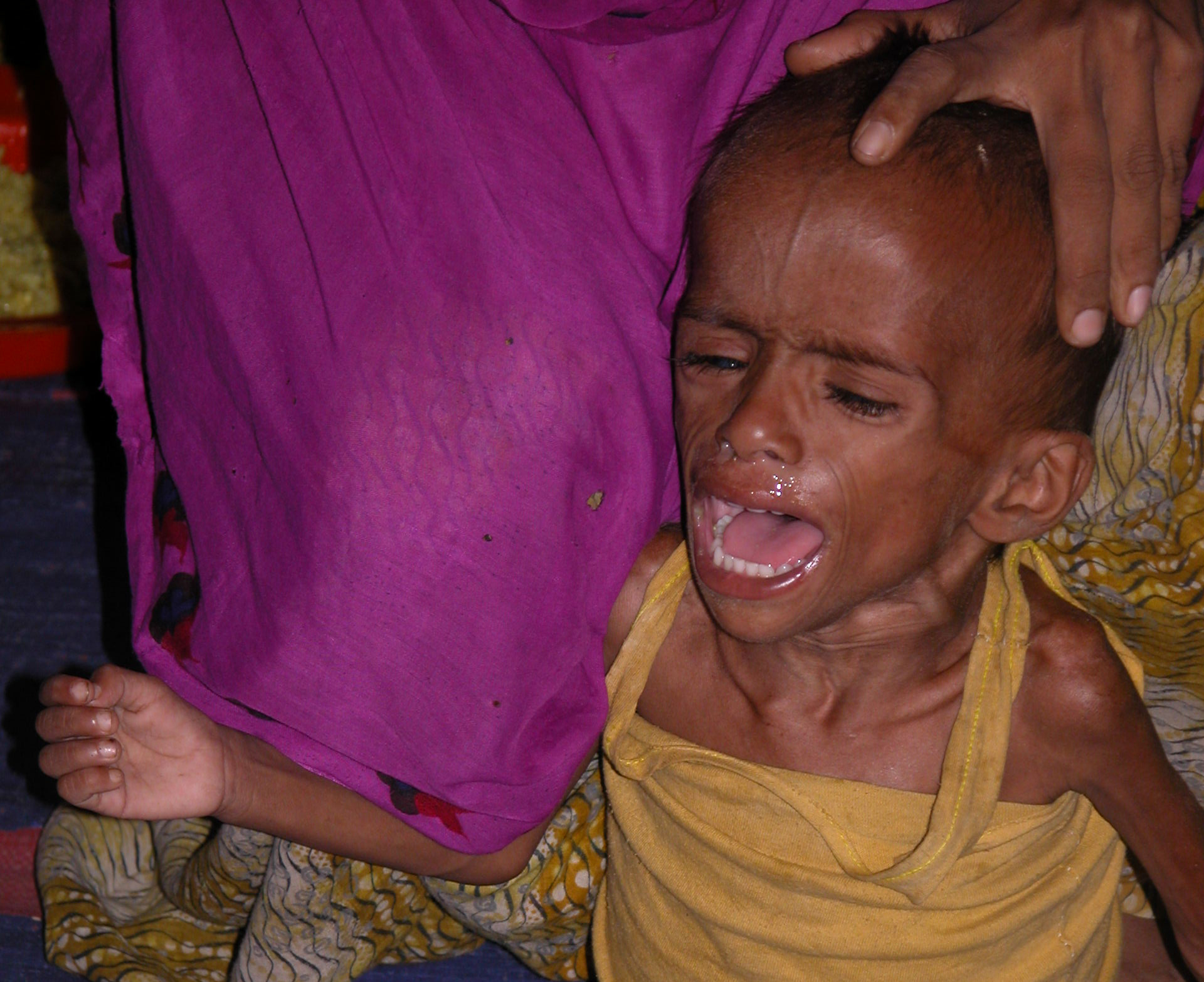 Severely malnourished children are repeatedly admitted for treatment at the
therapeutic nutrition centre in Leda, the site for undocumented Rohingyas