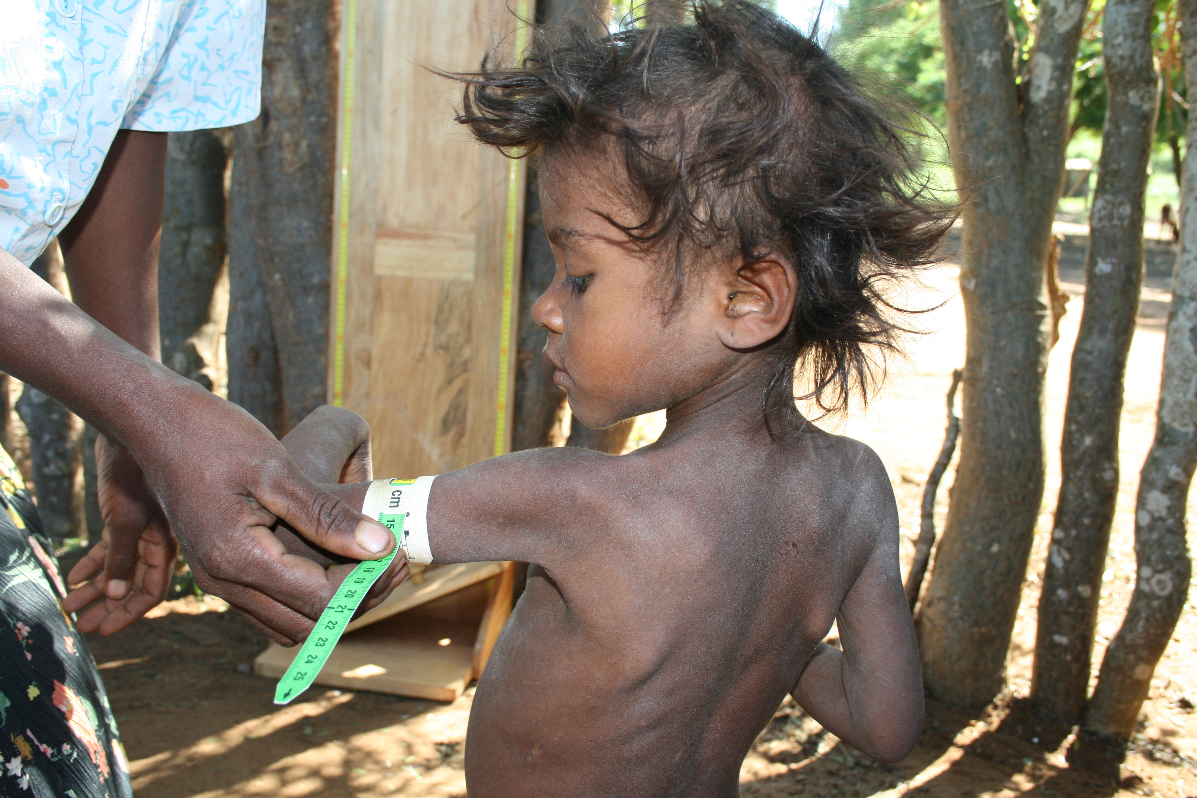 Screening has revealed thousands of children are severely malnourished in Madagascar’s parched south