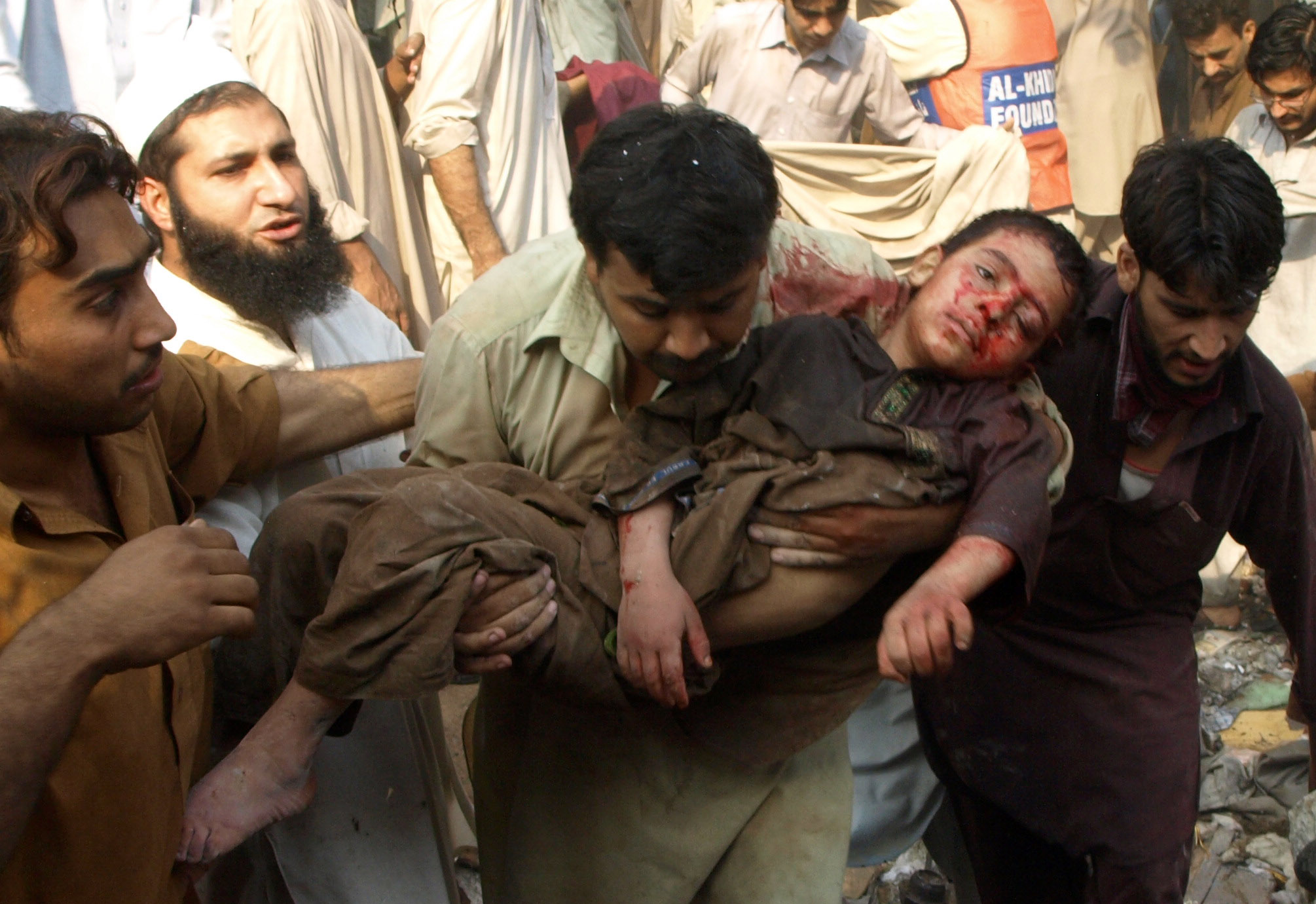 Many of the wounded in the Peshawar bomb blast were women and children