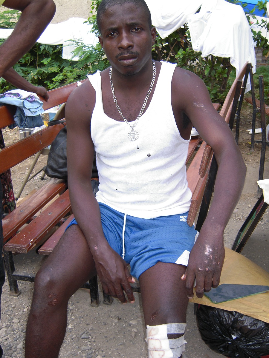 Jean Paul Erreur, cured but now homeless patient in Jacmel, Haiti where 7000 homes were completely destroyed 