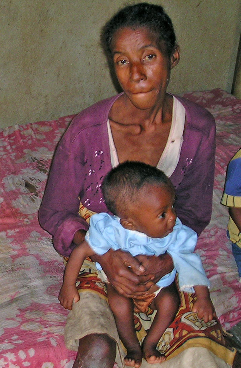 Edwige Solo and her seven month old child at a nutritional centre in the east coast Madagascan town of Brickaville