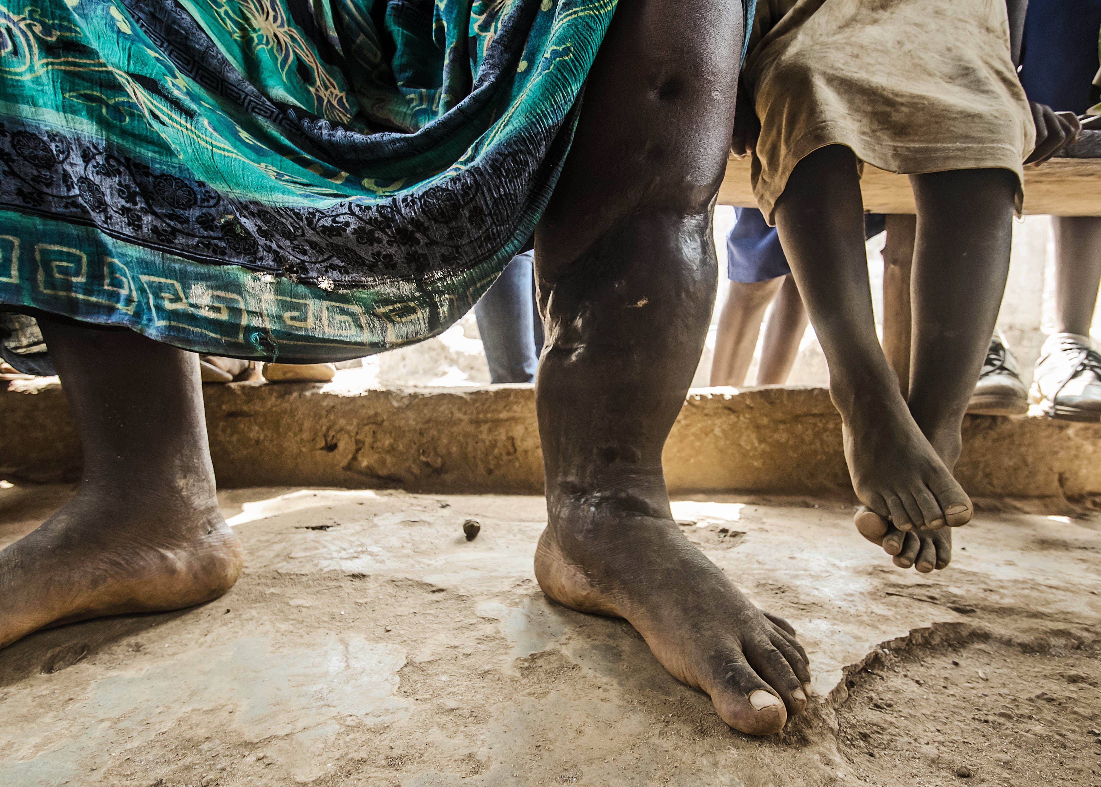 A mother whose leg was injured in Adonkia quarry, Freetown, Sierra