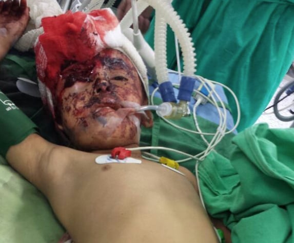 Children bear brunt of Yemen’s war Amel Naser six receives treatment at the military hospital in Sanaa Shawb district Sana'a after suffering injuries in her eye face and leg from the explosion caused by the Noqum mountain attack in May 2015