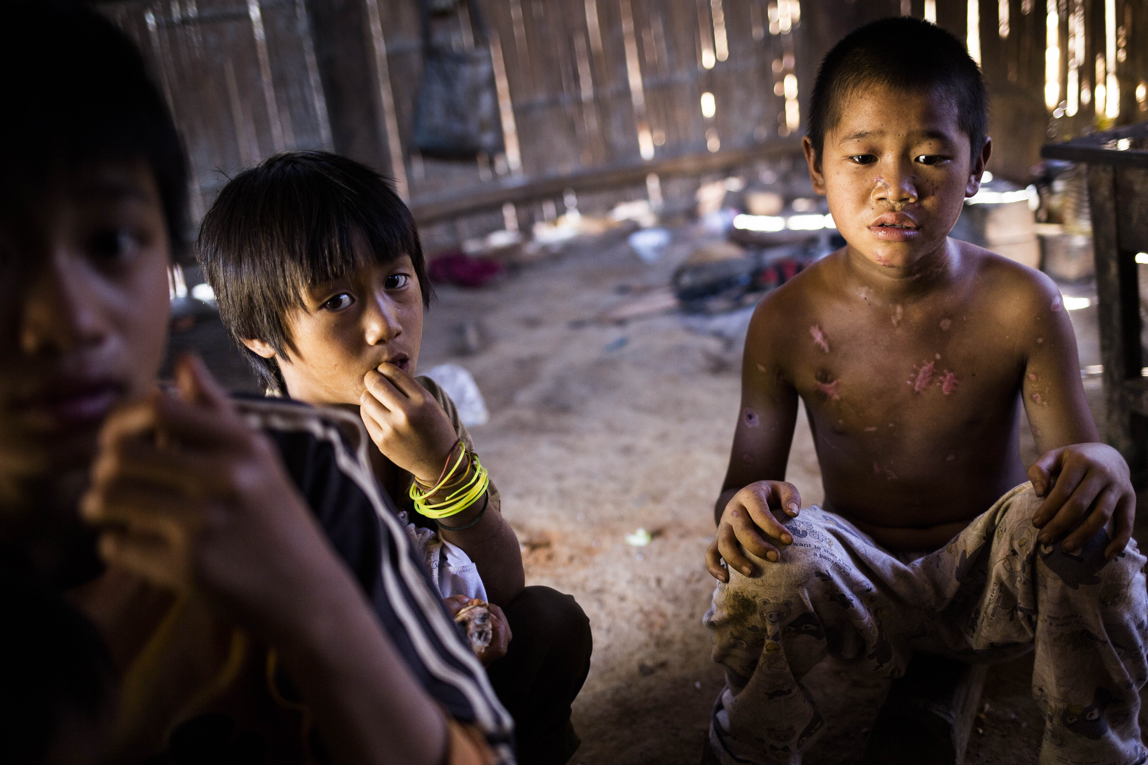 Luo Ben Cing, 10, shown in November 2015 displaying injuries he received from a landmine explosion in Myanmar's Shan State