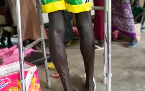 A Lou Nuer youth uses a walking aid to limp through a hospital ward in Bor hospital, Bor town, Jonglei State, South Sudan, Monday, July 15, 2103. Fierce clashes between rival ethnic groups have again erupted in eastern Jonglei state, causing 144 wounded t