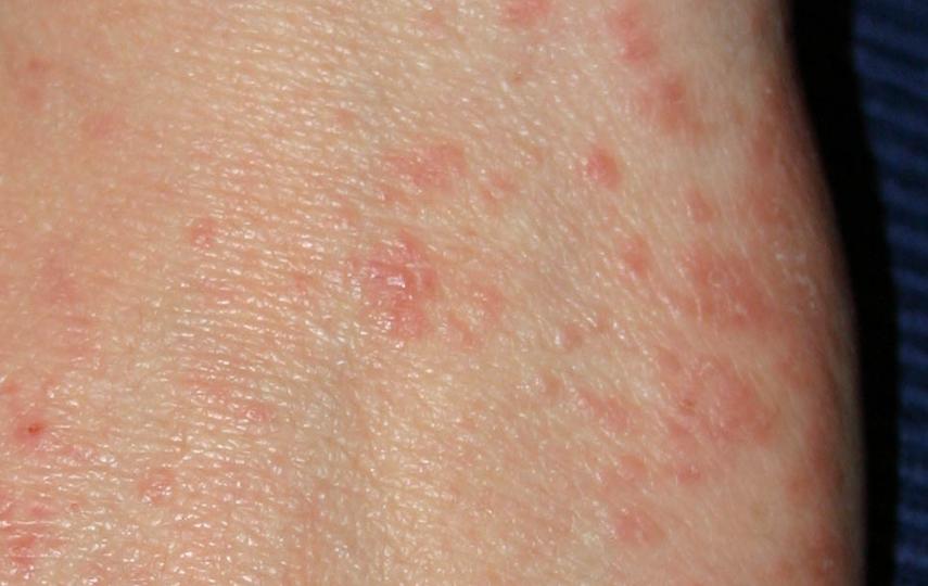 Scabies is a contagious infection caused by a mite which in turn causes intense itching and inflammation.