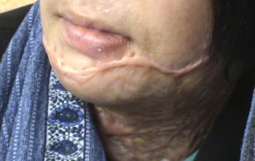 Self-immolation has been practiced by desperate women who lack access to justice and protection