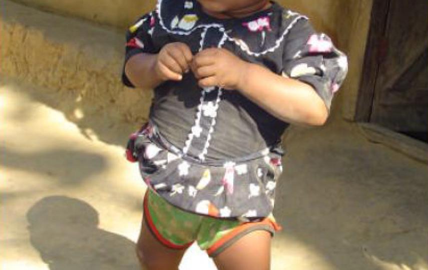 The appearance of rickets usually associated with a lack of sunlight in Bangladesh is unexpected