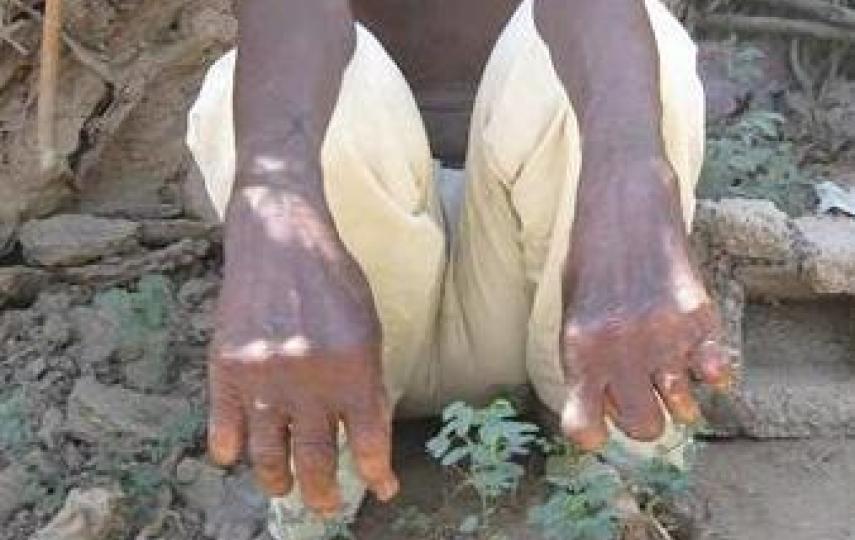 Ade Sheikdon Negeye, a leprosy patient from Beletweyne, central Somalia, displays his diseased limbs