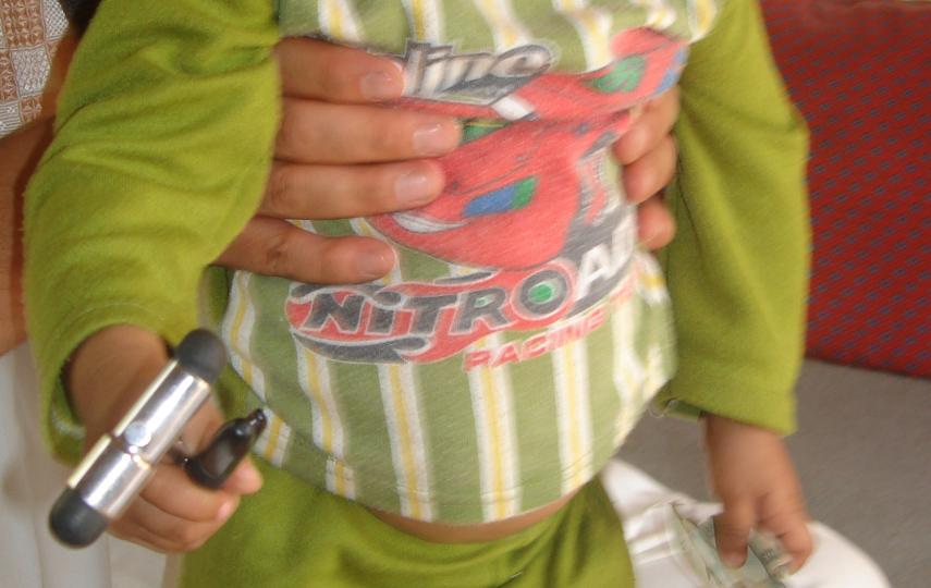 A 13-month child paralyzed by polio