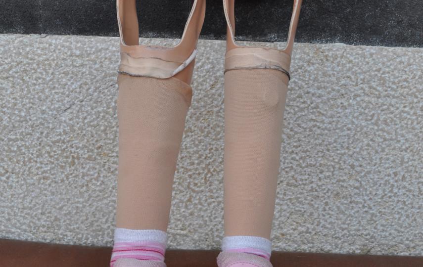 Dozens of refugees living with disabilities, mostly children, are waiting for treatment and artificial limbs