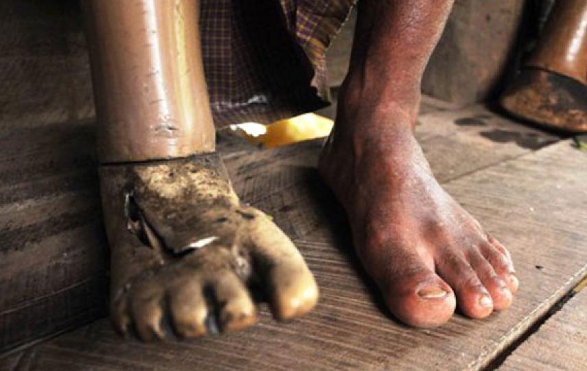 Zaw Lwin, 42, lost his leg to a landmine 12 years ago in the eastern part of Myanmar's Bago Region. 34 of the country's 325 townships - home to 5.2 million people - are considered landmine-contaminated