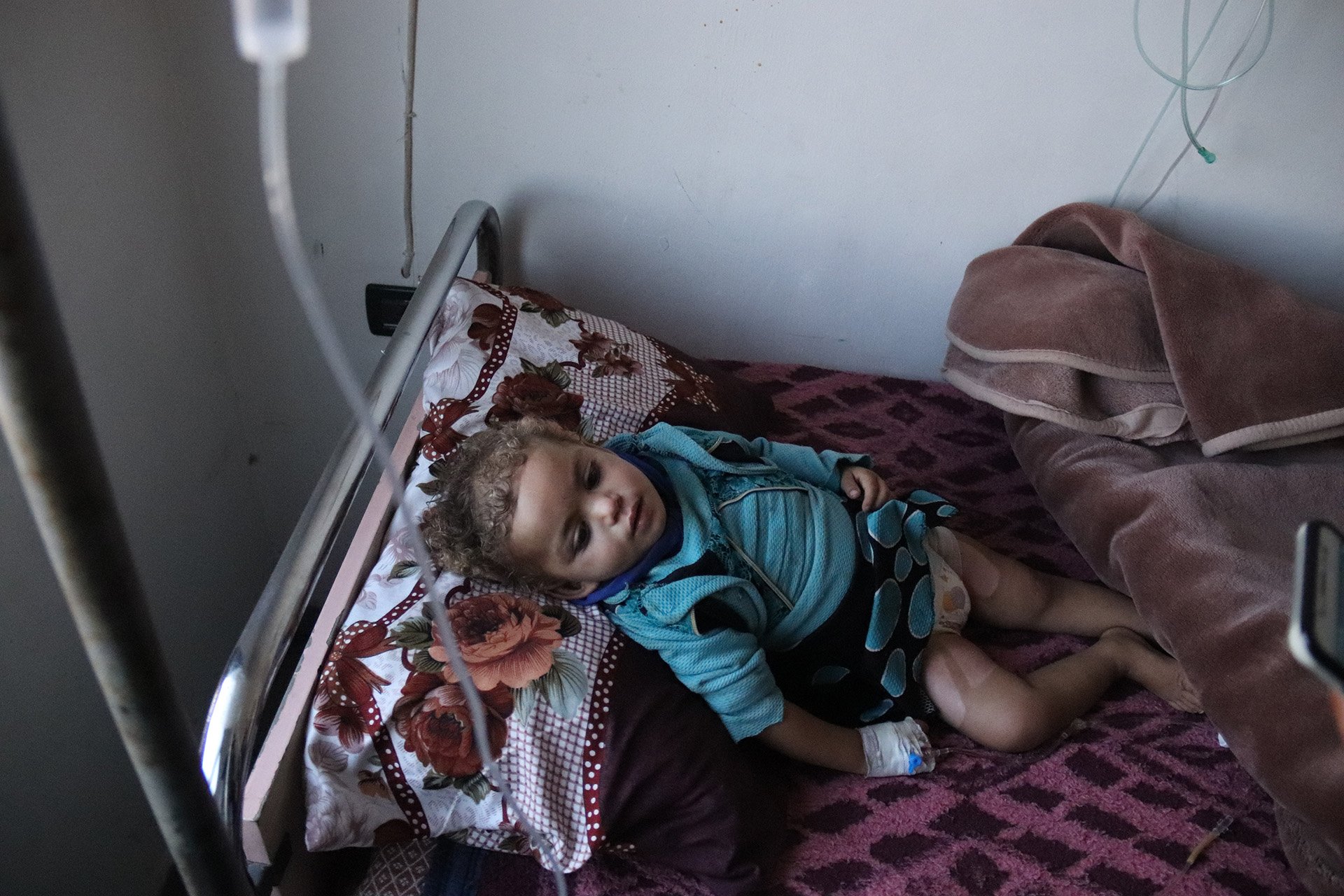 Ayat, a two-year-old girl, suffered third degree burns when her family’s tent caught fire in their camp near the Turkish border in December. 