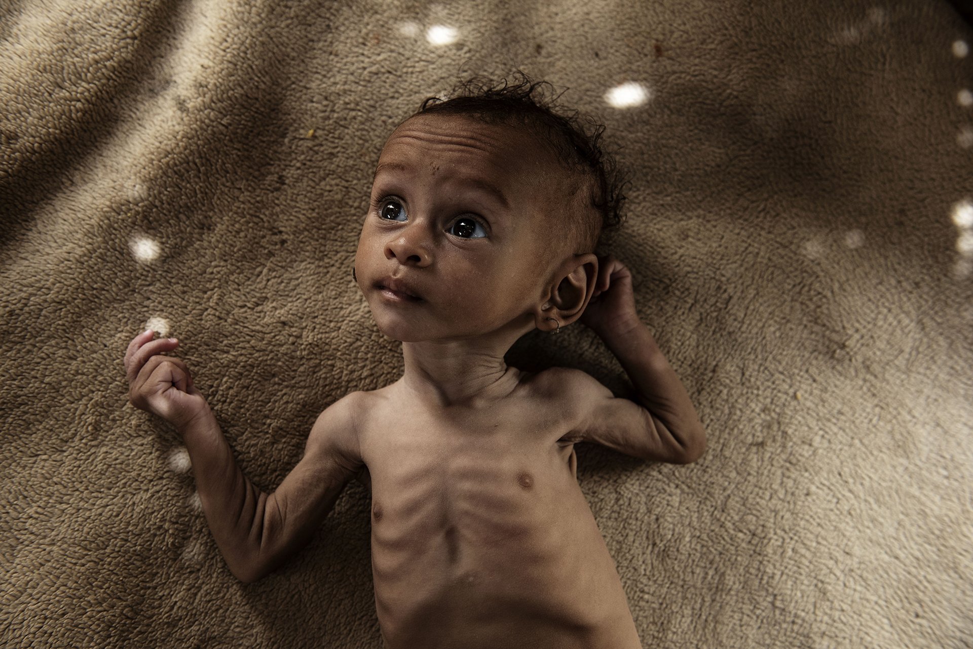 Photo of a malnourished child in rural Yemen